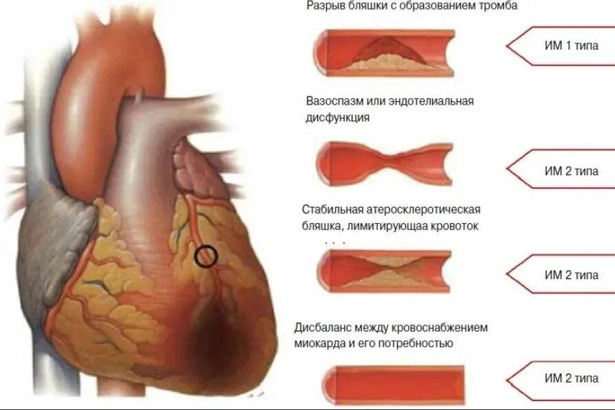 Инфаркт миокарда сердце. Изменения в сердце при инфаркте миокарда. Тромб в правом