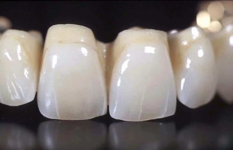 Временные пластмассовые зубы. Пластиковые коронки. Пластмассовая коронка на зуб. Несъемный металлопластмассовый мостовидный протез. Временные пластмассовые зубы.