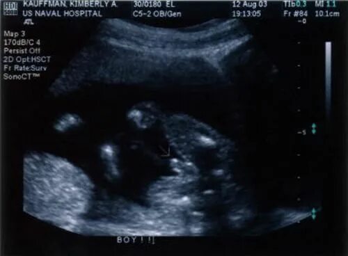 Ребенок на 20 неделе беременности узи. 20 Недель беременности фото плода на УЗИ. УЗИ 16 недель беременности мальчик. УЗИ плода на 20 неделе беременности. Снимок УЗИ беременности 20 недель.
