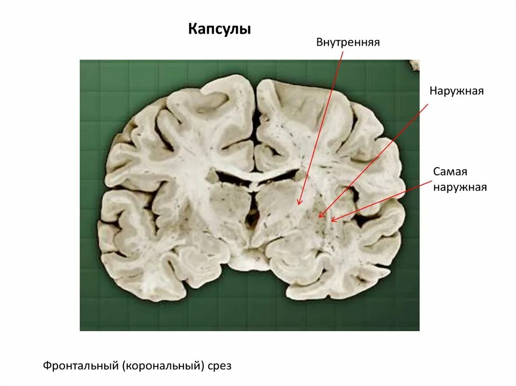 Хвостатое ядро мрт анатомия. Базальные ганглии головного мозга. Базальные ганглии анатомия. Бледный шар скорлупа хвостатое ядро. Изменение в базальных отделах