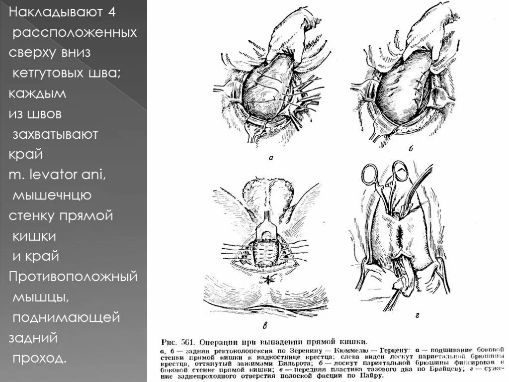 Выпадение прямой кишки тесты. Операция Зеренина-Кюммеля-Герцена. Операция Тирша при выпадении прямой кишки. Выпадение прямой кишки операция Зеренина-Кюммеля. Операции при выпадении прямой кишки Зеренина Кюммеля Герцена техника.