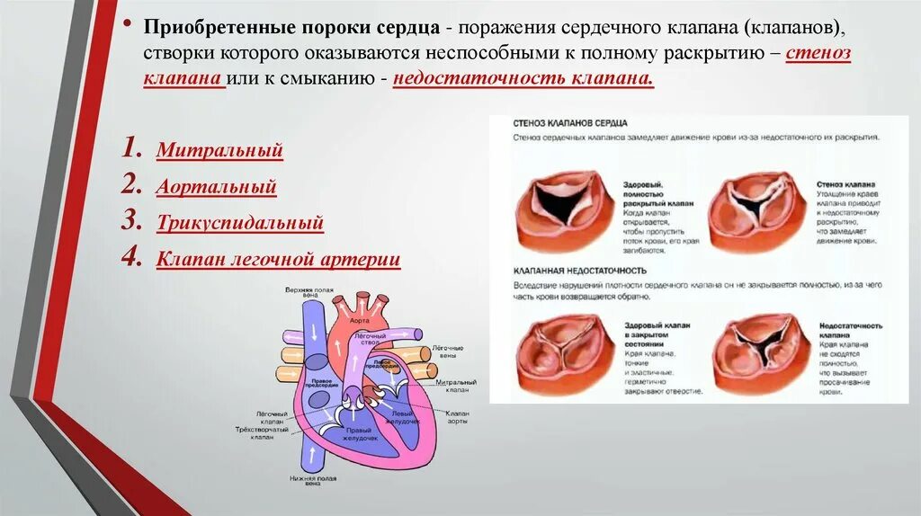 Классификация пороков митрального клапана. Приобретенные пороки аортального клапана. Перечислите основные виды приобретенных пороков сердца.. Аортальный клапан и легочный клапан.