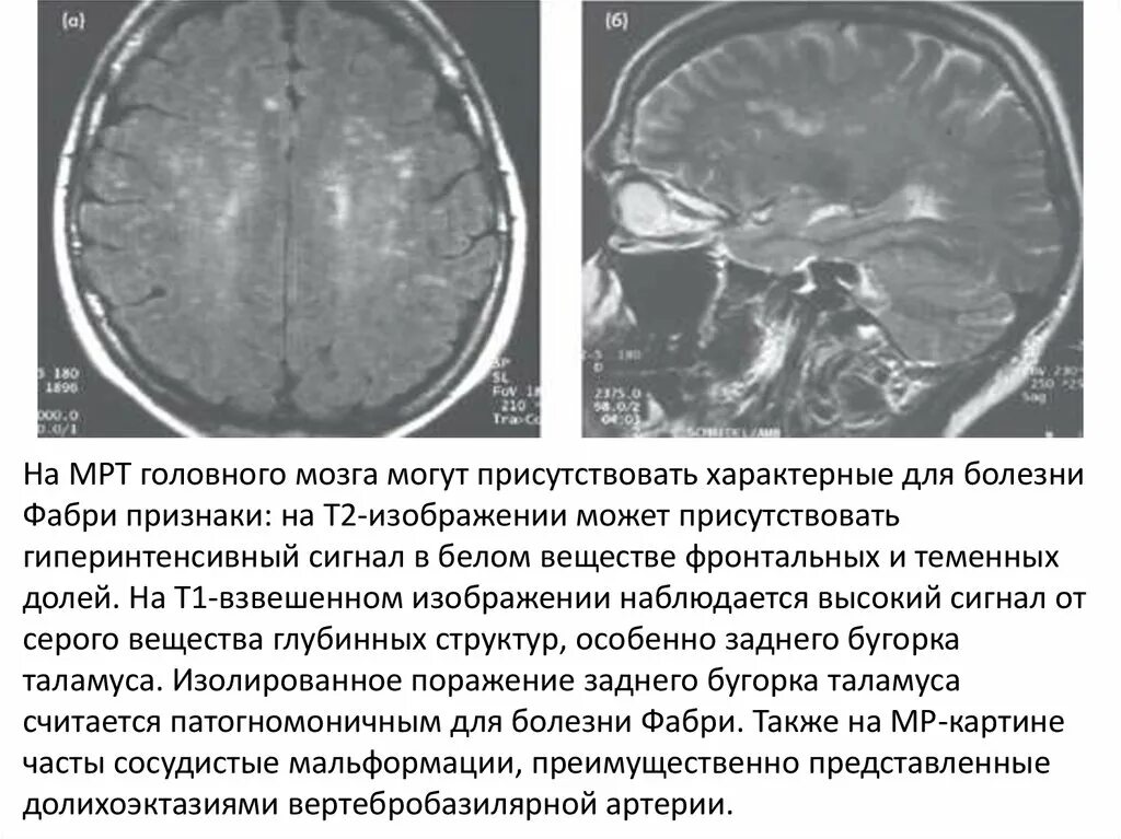 Поражение белого вещества мозга. Мрт головного мозга болезнь Фабри. Болезни белого вещества головного мозга. Заболевания головного мозга на мрт.