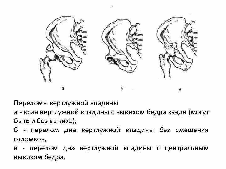 Скошенный кзади профиль. Перелом заднего края большеберцовой кости рентген. Подвывих голеностопного сустава классификация. Переломы крестца классификация. Перелом дистального отдела большеберцовой кости классификация.