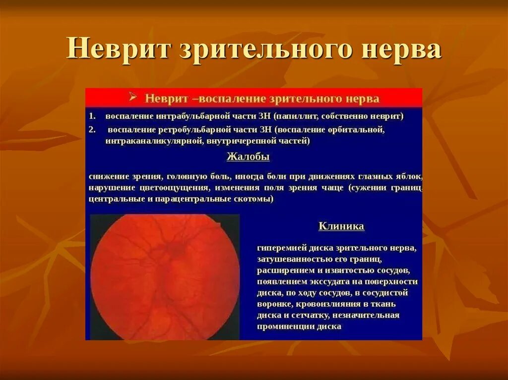 Почему воспаляется нерв. Оптический неврит папиллит. Клиника поражения зрительного нерва. Субъективные и объективные симптомы при неврите зрительного нерва. Неврит глазного нерва ретробульбарный.