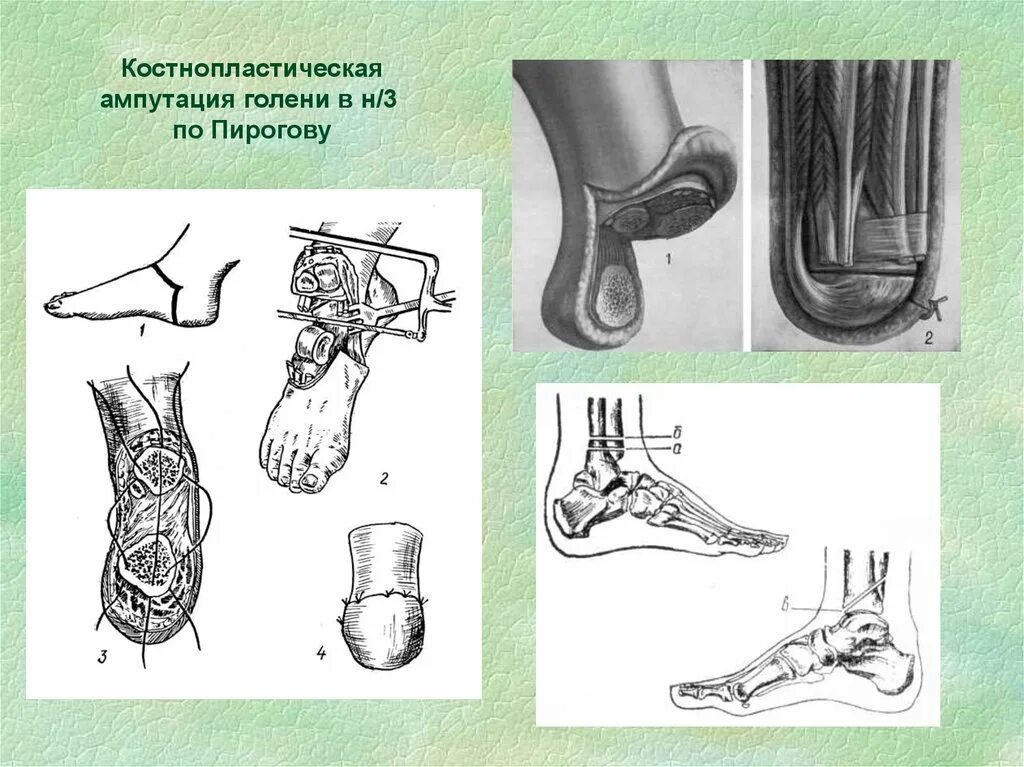 Костно пластическая ампутация голени по Пирогову. Костнопластическая ампутация Пирогова. Однолоскутная ампутация голени. Ампутация Пирогова голени.