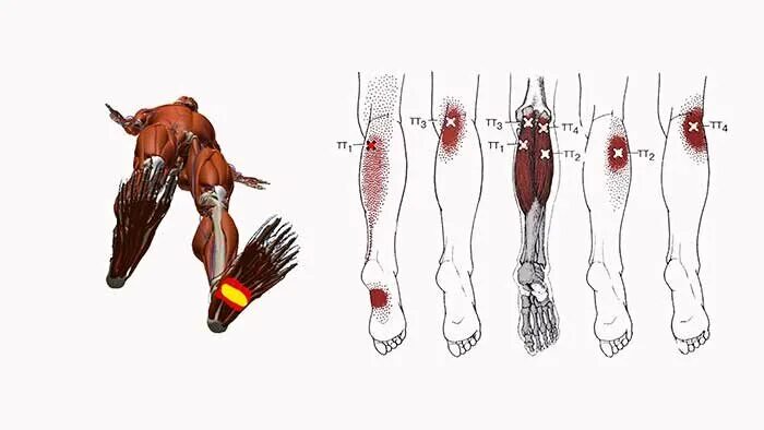 Длинный сгибатель стопы. Триггерные точки стопы. Сгибатель большого пальца стопы триггерная точка. Сгибатели пальцев стопы триггерные точки. Триггерные точки икроножной мышцы.