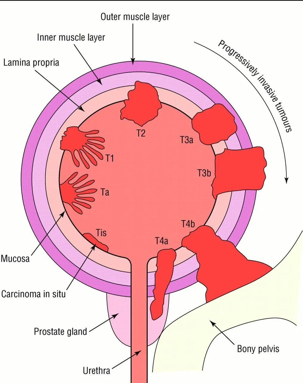 Паравезикальная клетчатка. Злокачественные новообразования мочевого пузыря классификация. Классификация опухоли мочевого пузыря TNM. Раковая опухоль мочевого пузыря. Злокачественная опухоль мочевого пузыря.