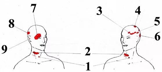 Болезненные точки на голове. Боль в голове в одной точке. Болит голова сверху слева. Точка на голове на макушке болит. Болит в одной точке головы с левой стороны.