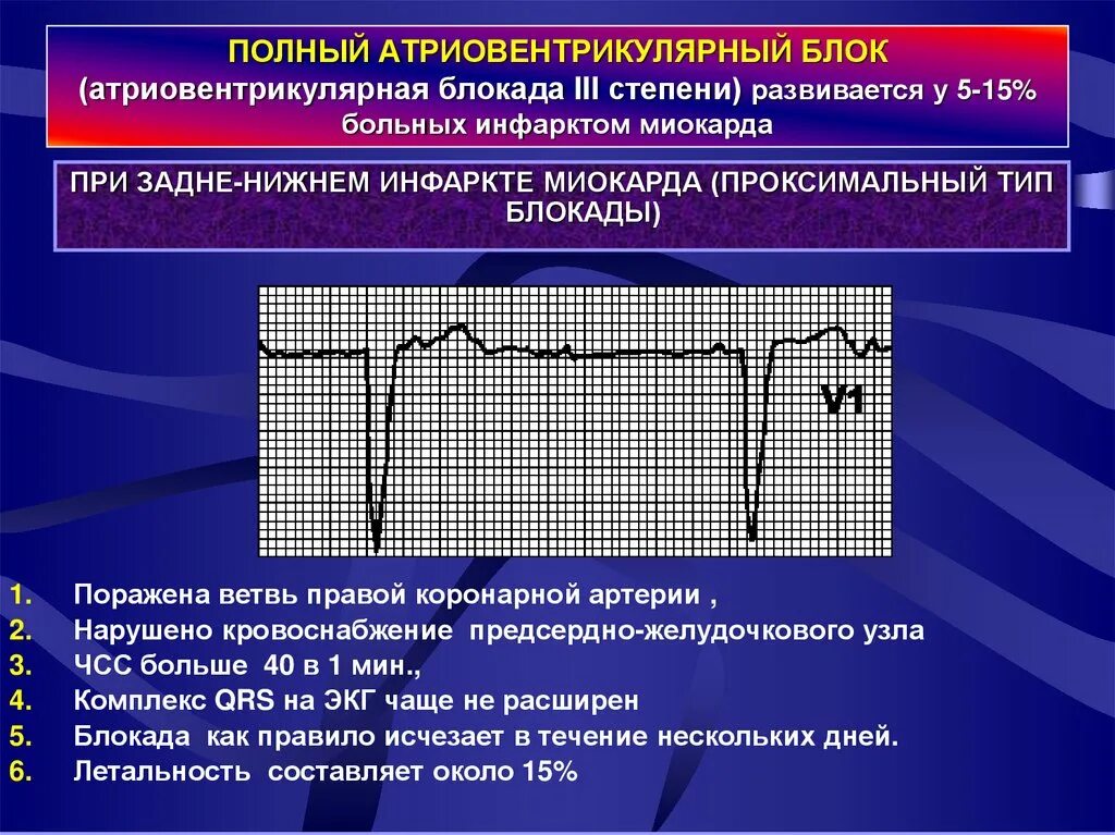 Полная атриовентрикулярная блокада. Полная атриовентрикулярная блокада III степени. Блокады при инфаркте миокарда. Атриовентрикулярная блокада инфаркт миокарда. АВ блокада при инфаркте миокарда.