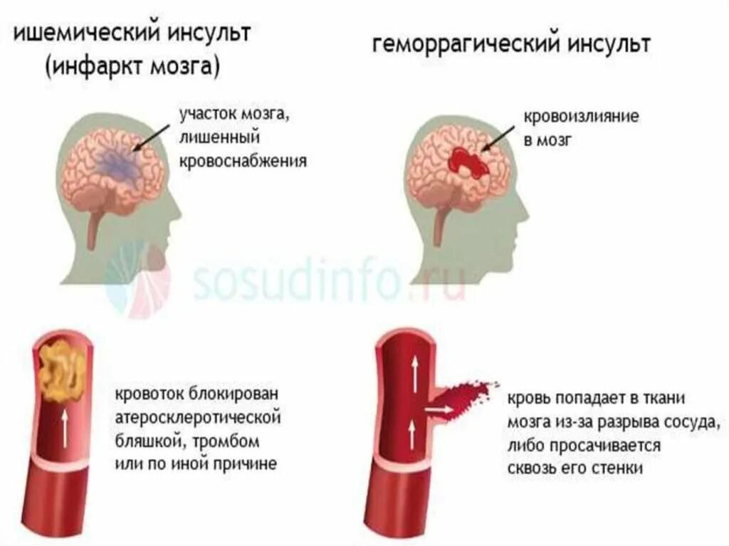 Тромбы после инсульта