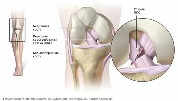 Задняя крестообразная связка коленного сустава анатомия. ACL колено связки коленного. Разрыв связок ПКС коленного сустава. Отрыв передней крестообразной связки. Полный разрыв передней крестообразной