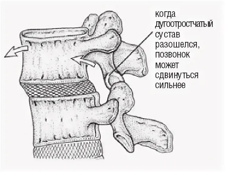 Дугоотростчатый сустав анатомия. Межпозвоночные дугоотростчатые суставы. Дугоотростчатый сустав форма. Соединение дуг позвонков анатомия. Дугоотросчатые суставы анатомия.