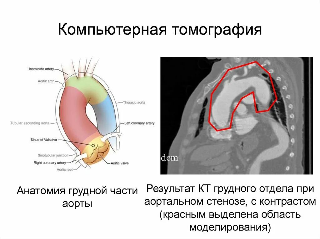 Уплотнение стенок аорты сердца на узи что. Уплотнение стенок аорты сердца на узи что