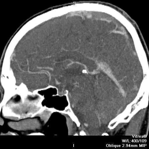 Тромбоз поперечного синуса. Тромбоз сагиттального синуса мрт. Аплазия поперечного синуса мрт. Тромбоз поперечного синуса мкб. Гипоплазия правого поперечного синуса