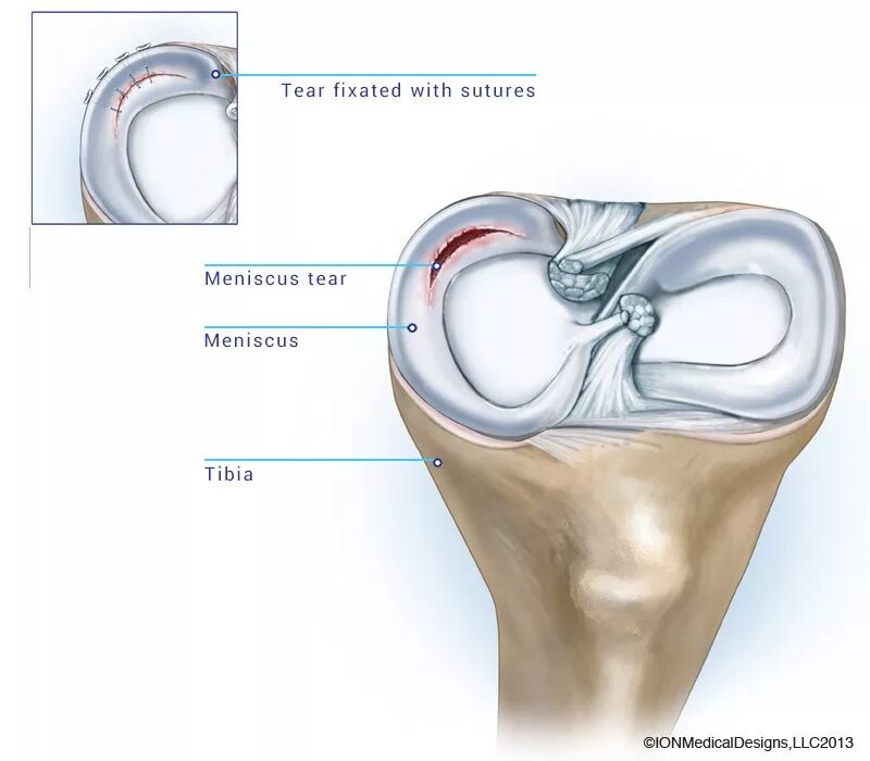 Изменение рога медиального мениска коленного сустава. Линейный разрыв мениска. Экструзия медиального мениска коленного. Радиально поперечный разрыв мениска. Менископатия медиального мениска.