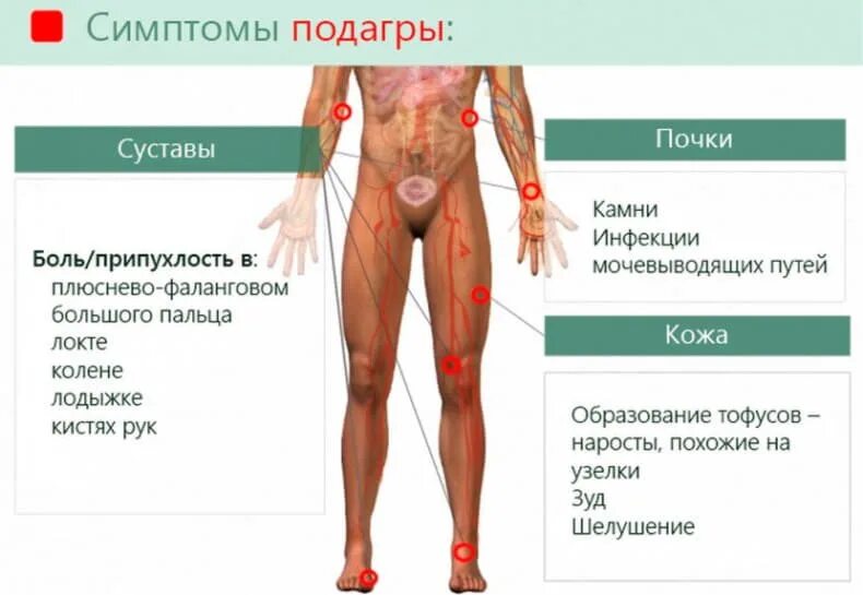 Подагра симптоматика болезни. Симптомы проявления подагры. Проявление подагры признаки. Почему болезнь королей