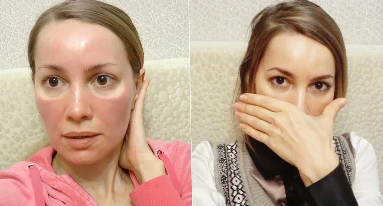 Пилинг джесснера сколько. Пилинг джесснера поверхностный. Пилинг джесснера jess peel. Профессиональный пилинг джесснера. Срединный химический пилинг.