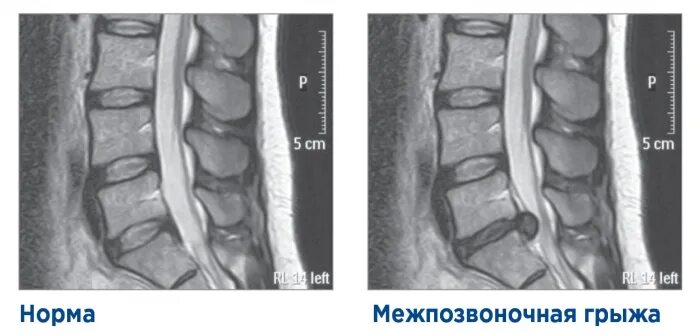 Зарядка при грыже поясничного отдела позвоночника ЗаПитание