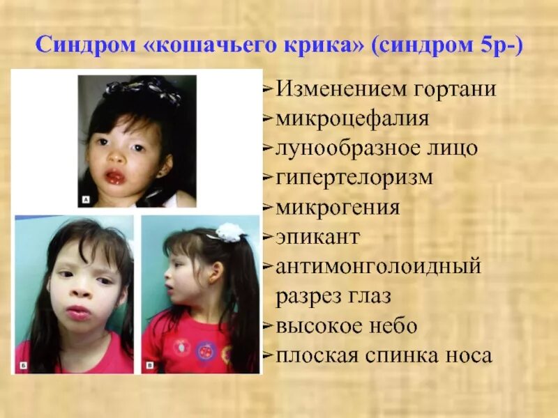 Что такое синдром крика. Что такое синдром крика