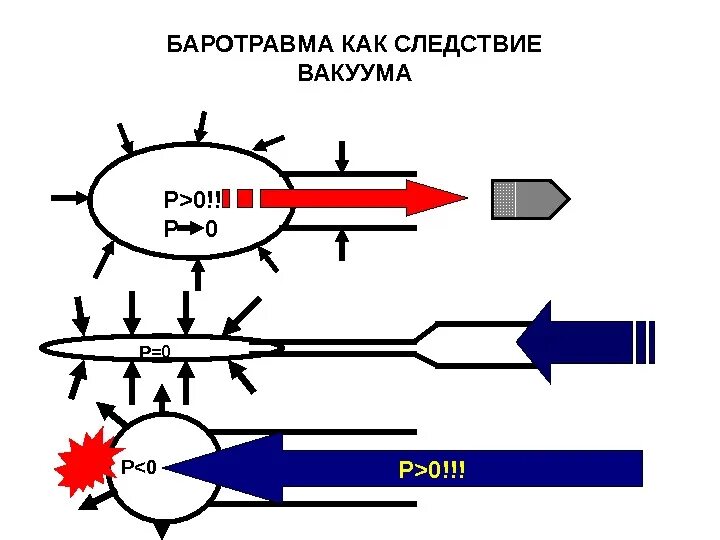 Патогенез баротравмы. Баротравма легких патогенез. Баротравма этиология. Классификация баротравм.