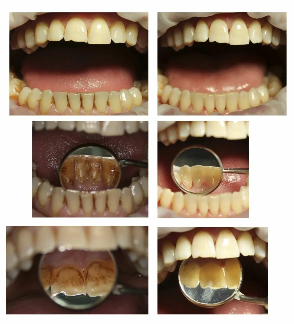 Профессиональная чистка зубов. Чистые зубы. ЧИТСК азуюов до и после. Чистка зубов после лечения
