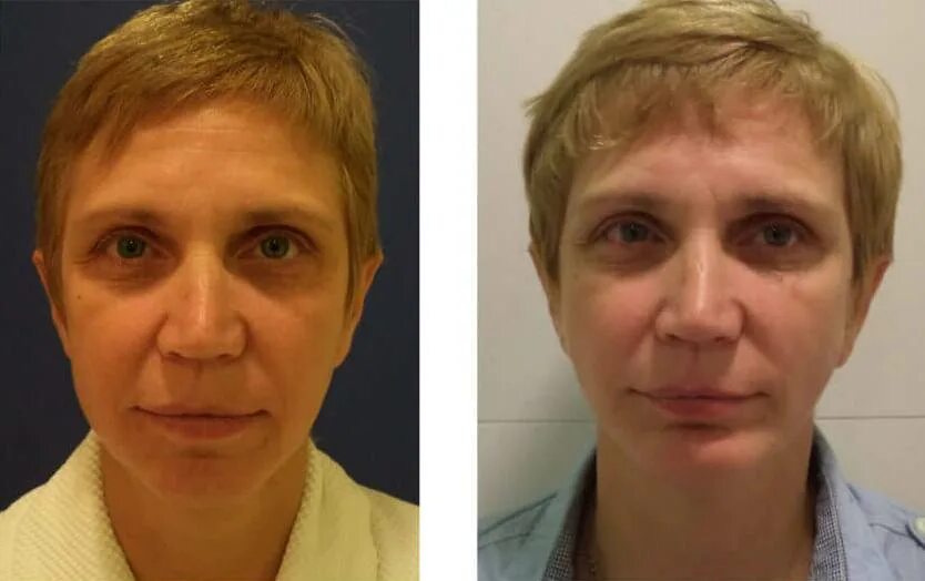 Лифтинг лица. Подтянутое лицо пластика. Пластика лица екатеринбург. Эндоскопический височный лифтинг (темпоропластика). Пластика лица екатеринбург.