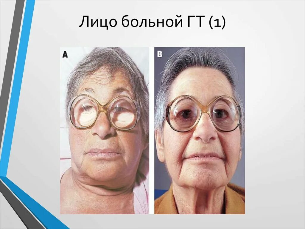 Гипотериоз после лечения. Выражение лица при гипертиреозе. Гипотиреоз выражение лица.