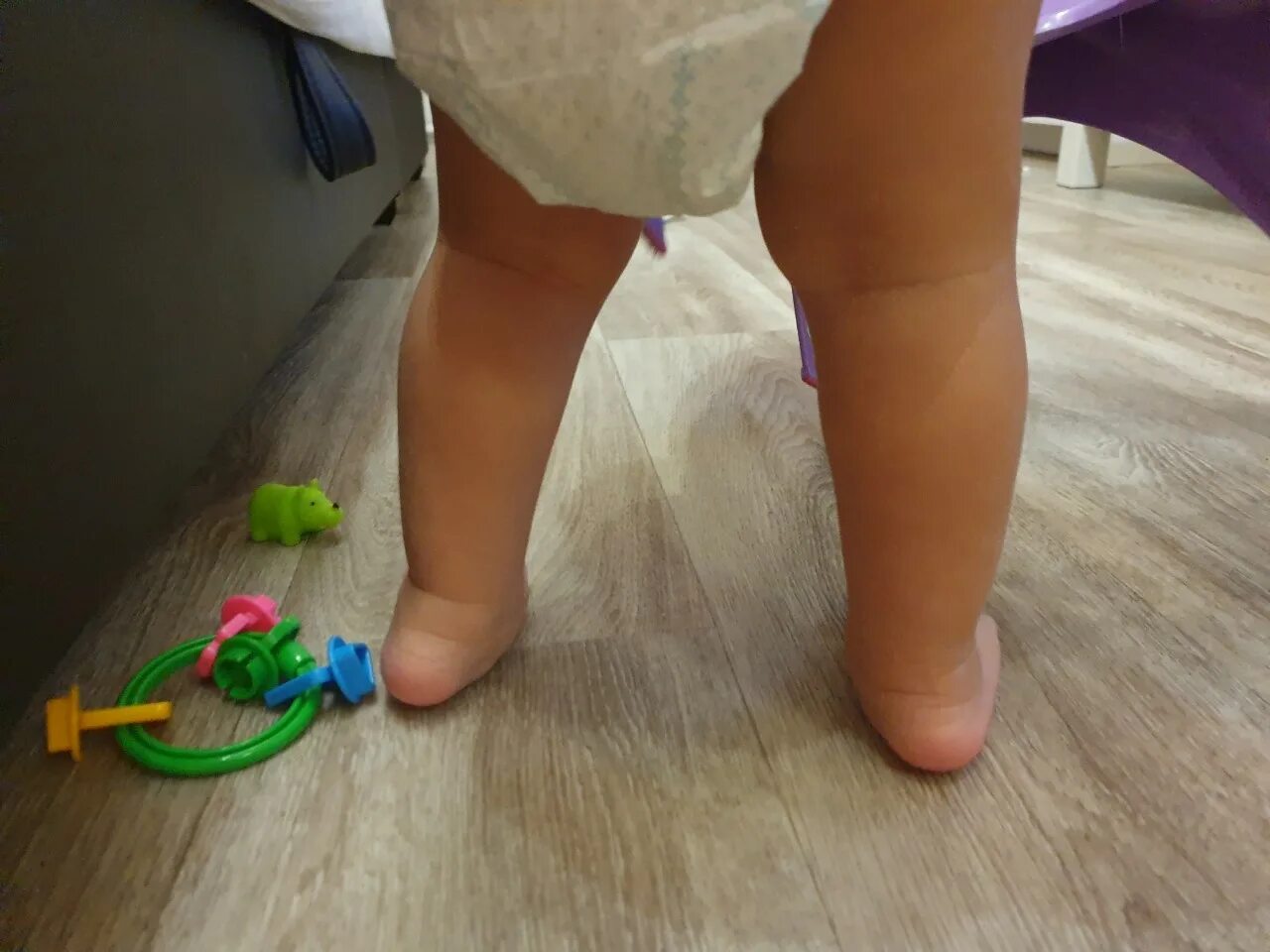 Плоско-вальгусная стопа. Вальгусная деформация стопы у ребенка 3 года.