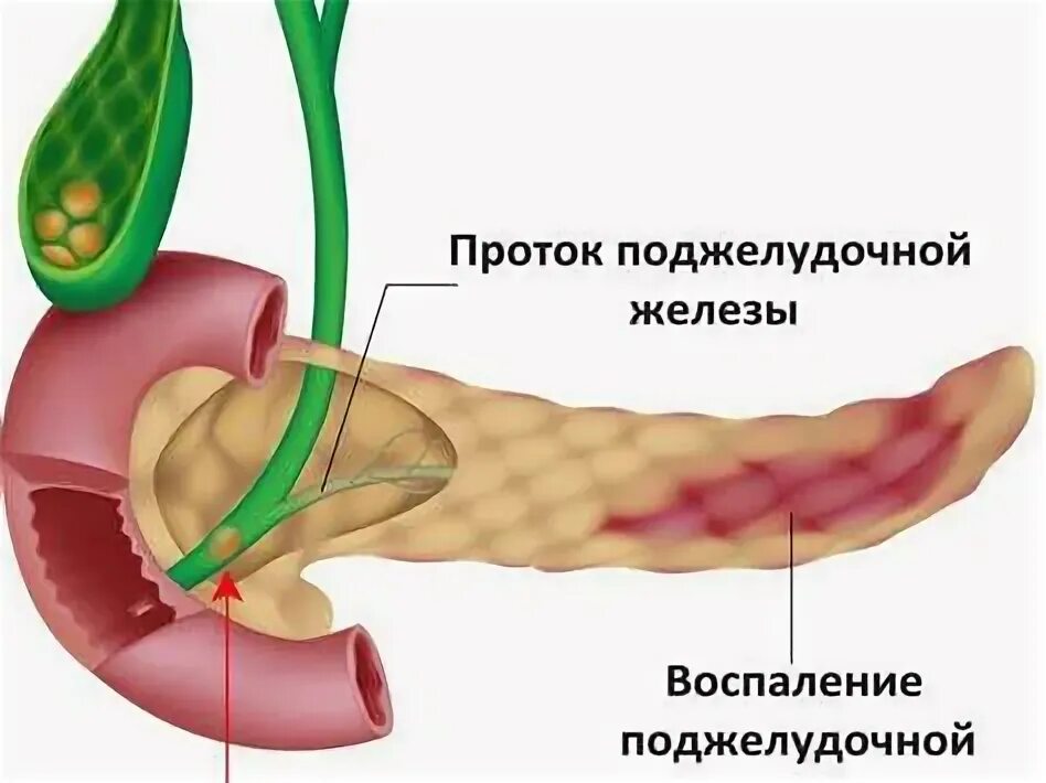 Как быстро снять приступ поджелудочной Панкреатит первый приступ