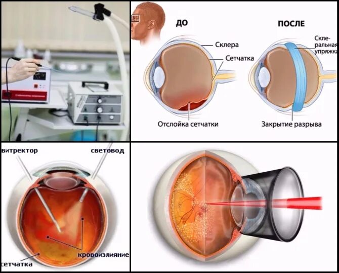 Как восстанавливается зрение после лазерной. Склеральное пломбирование сетчатки. Пузыревидная отслойка сетчатки. Отслойка сетчатки циркляж. Неопластическая отслойка сетчатки.