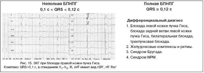 Опасна ли неполная блокада. Неполная блокада правой ножки пучка Гиса на кардиограмме. Блокада правой ножки пучка Гиса на ЭКГ. Блокады ножек Пучков Гиса на ЭКГ. Неполная блокада правой ножки пучка на ЭКГ.