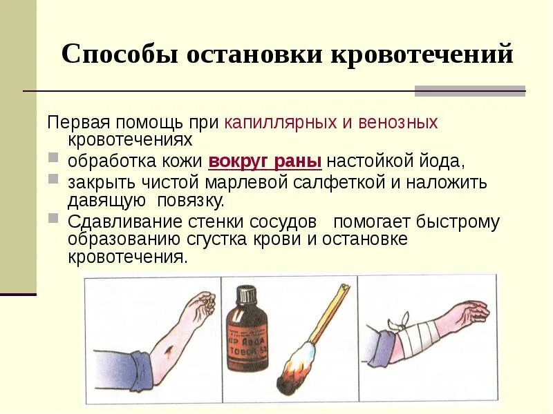 Метод остановки капиллярного кровотечения. Методы остановки артериального и венозного кровотечения. Метод остановки кровотечения венозного артериального. Остановка кровотечения артериального венозного и капиллярного.