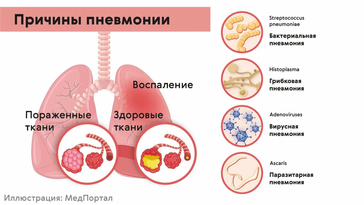 Почему болеют пневмонией