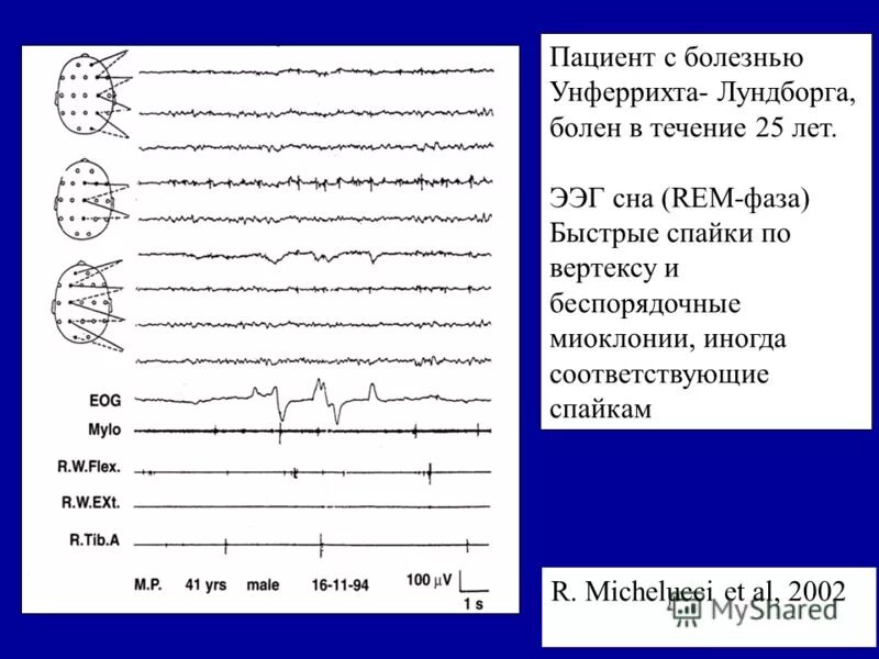 Ээг тверь. Rem фаза сна ЭЭГ. Rem non Rem фазы сна. Миоклония на ЭЭГ. Миоклонус эпилепсия Унферрихта Лундборга.