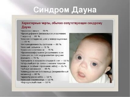 Синдром дауна развитие