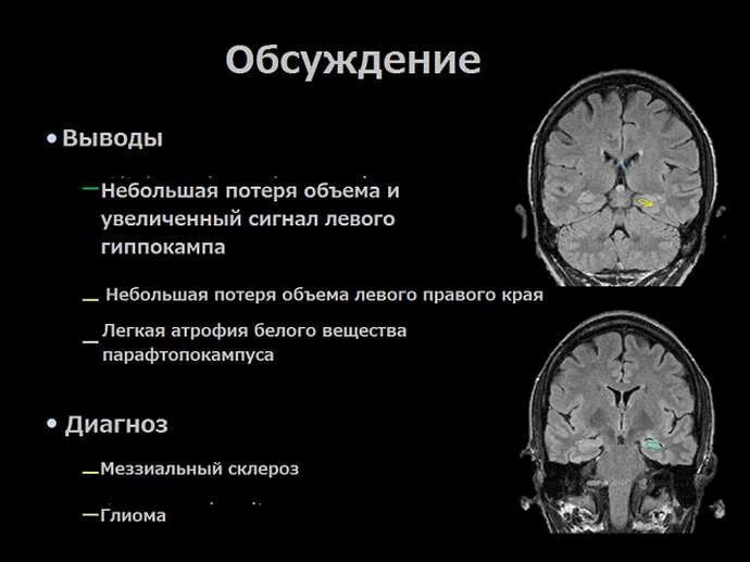 Атрофия головного мозга продолжительность. Склероз гиппокампа эпилепсия. Гиппокамп на мрт при эпилепсии. Гиппокамп мрт анатомия. Анатомия гиппокампа на мрт.