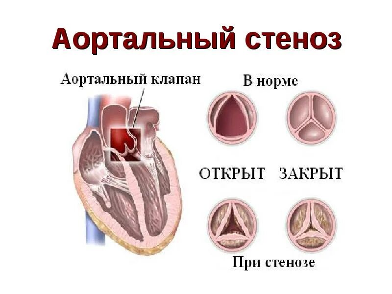 Сердечный стеноз. Пороки сердца митральный стеноз. Порок сердца стеноз аортального клапана. Митральные пороки сердца (стеноз, недостаточность. Стеноз и недостаточность аортального клапана.