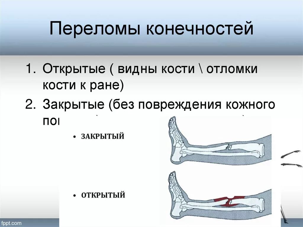 При открытом переломе ответ на тест. Переломы переломы кости. Открытый и закрытый перелом. Закрытый перелом конечности. Переломы костей закрытый открытый.