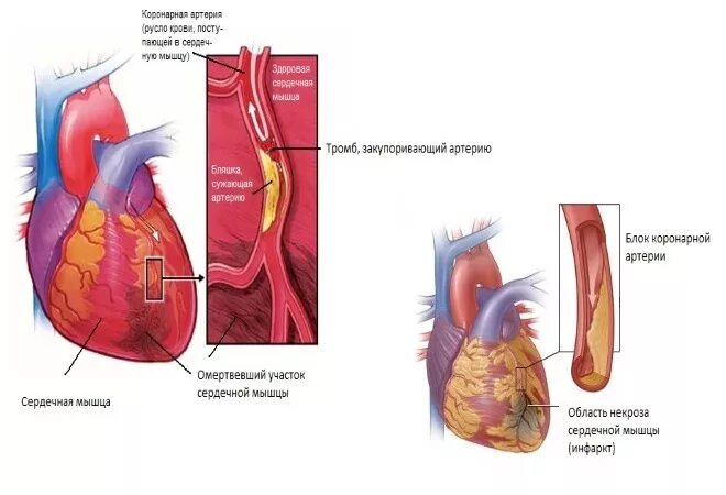 Тромбоз коронарных артерий причины. Закупорка тромбов в коронарной артерии. Тромб в сердце оторвался. Сердечный тромбоз