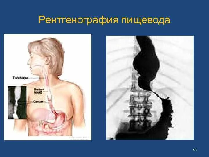 Рентгенологическое исследование пищевода. Рентгенограмма пищевода. Рентгенография пищевода и желудка. Рентгеноскопия желудка и пищевода.