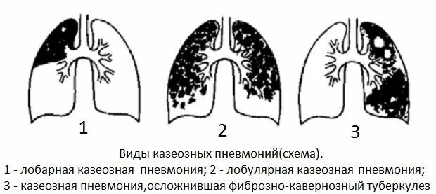 Казеозная пневмония фтизиатрия классификация. Казеозная пневмония лобарная форма рентген. Лобулярная казеозная пневмония рентген. Ацинозная казеозная пневмония рентген.