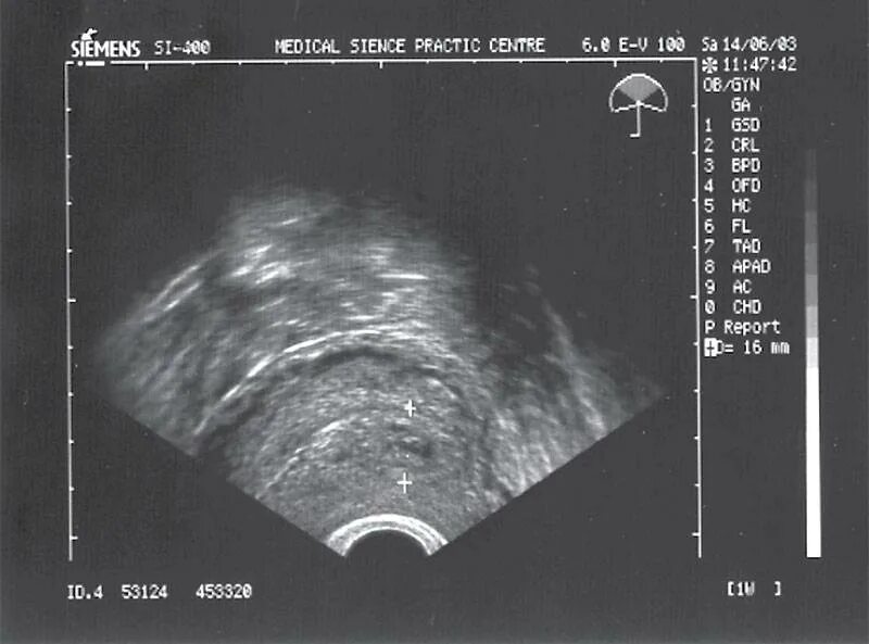 Маточная беременность на ранних сроках. Ультразвуковое исследование при беременности раннего срока. УЗИ беременности на ранних сроках. УЗИ на первых сроках беременности. УЗИ матки на первых неделях беременности.