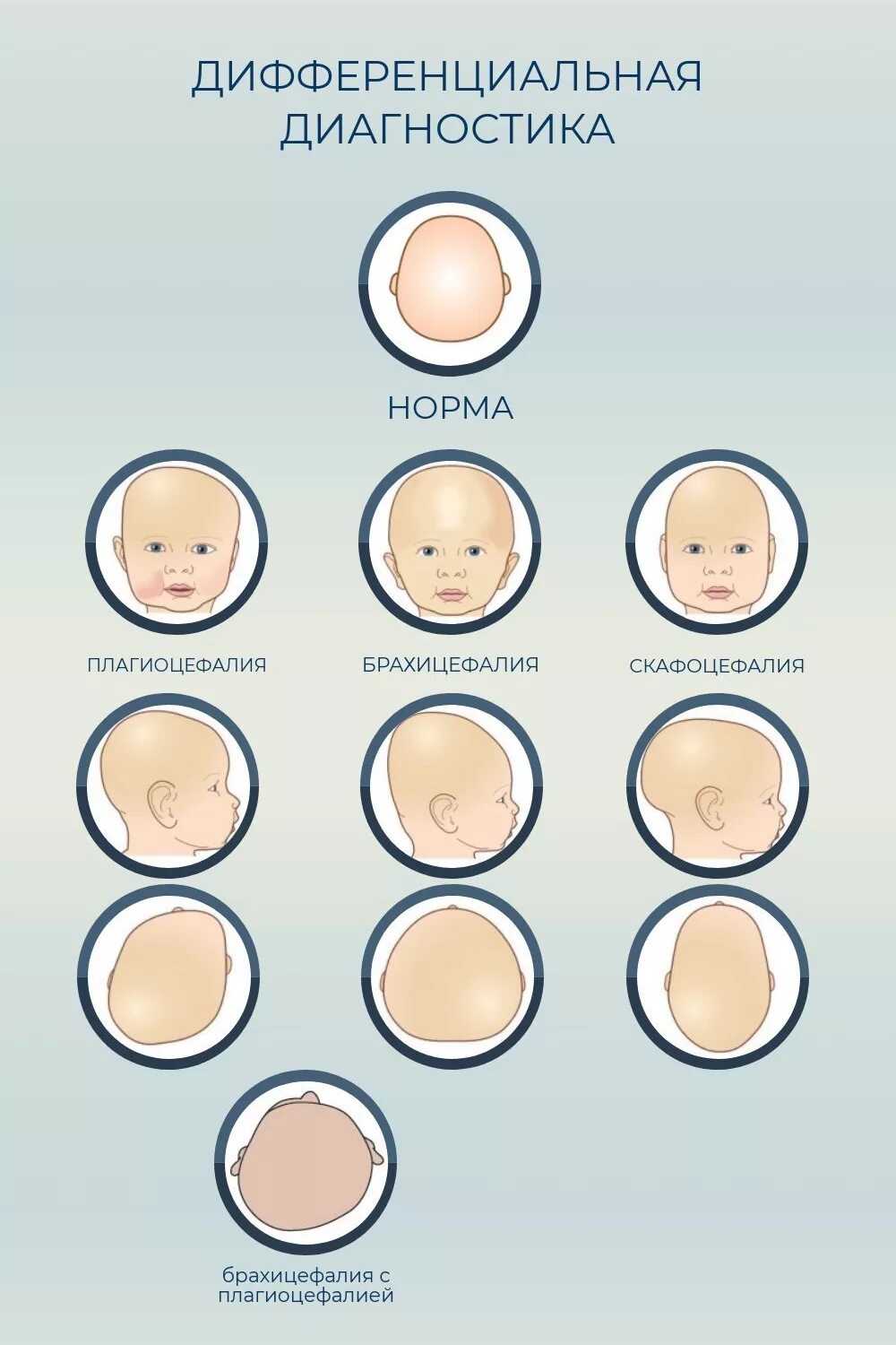 Форма головы у 2 месячного ребенка норма. Нормальная форма головы у новорожденного ребенка. Форма черепа у грудничка 4 месяца. Форма головы брахицефалическая у ребенка 3 года.