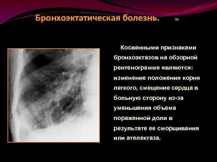 Бронхоэктатическая болезнь легкого рентген. Бронхоэктаз правого легкого. Бронхоэктатическая эмфизема. Бронхография бронхоэктазы. Хронический бронхит бронхоэктатическая болезнь.
