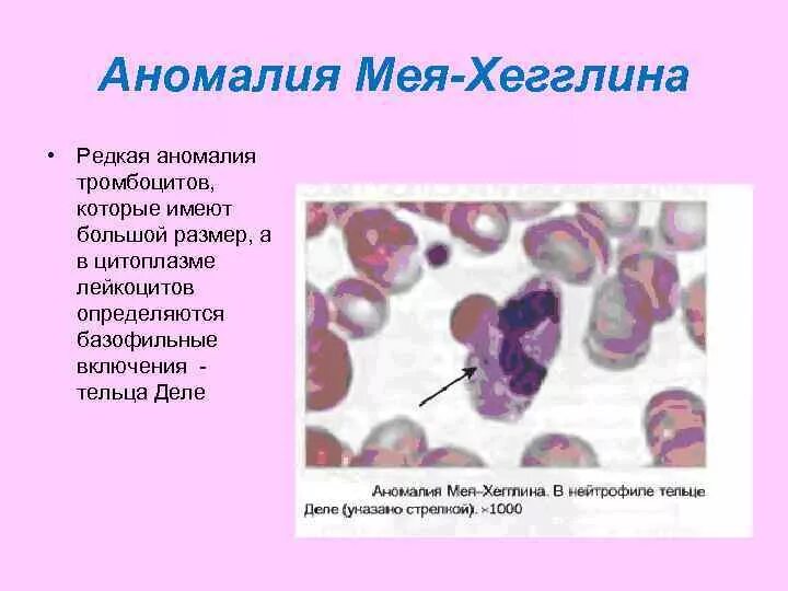 Патология лейкоцитов. Аномалия лейкоцитов Пельгера. Наследственные аномалии лейкоцитов. Нейтрофилы при аномалии Пельгера. Аномалия Мея-Хегглина.