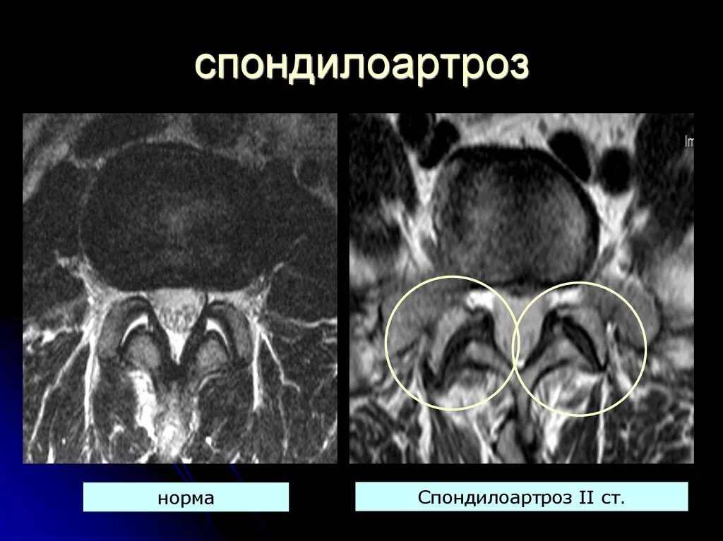 Спондилоартроз кт. Фасеточный синдром поясничного отдела рентген. артроз фасеточных суставов мрт. фасеточные дугоотросчатые суставы позвоночника. спондилоартроз фасеточный синдром.