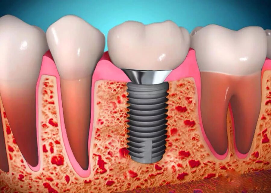 Внутрикостные дентальные имплантаты. Внутрикостная дентальная имплантация. Коронка абатмент формирователь. 3 зуба установить