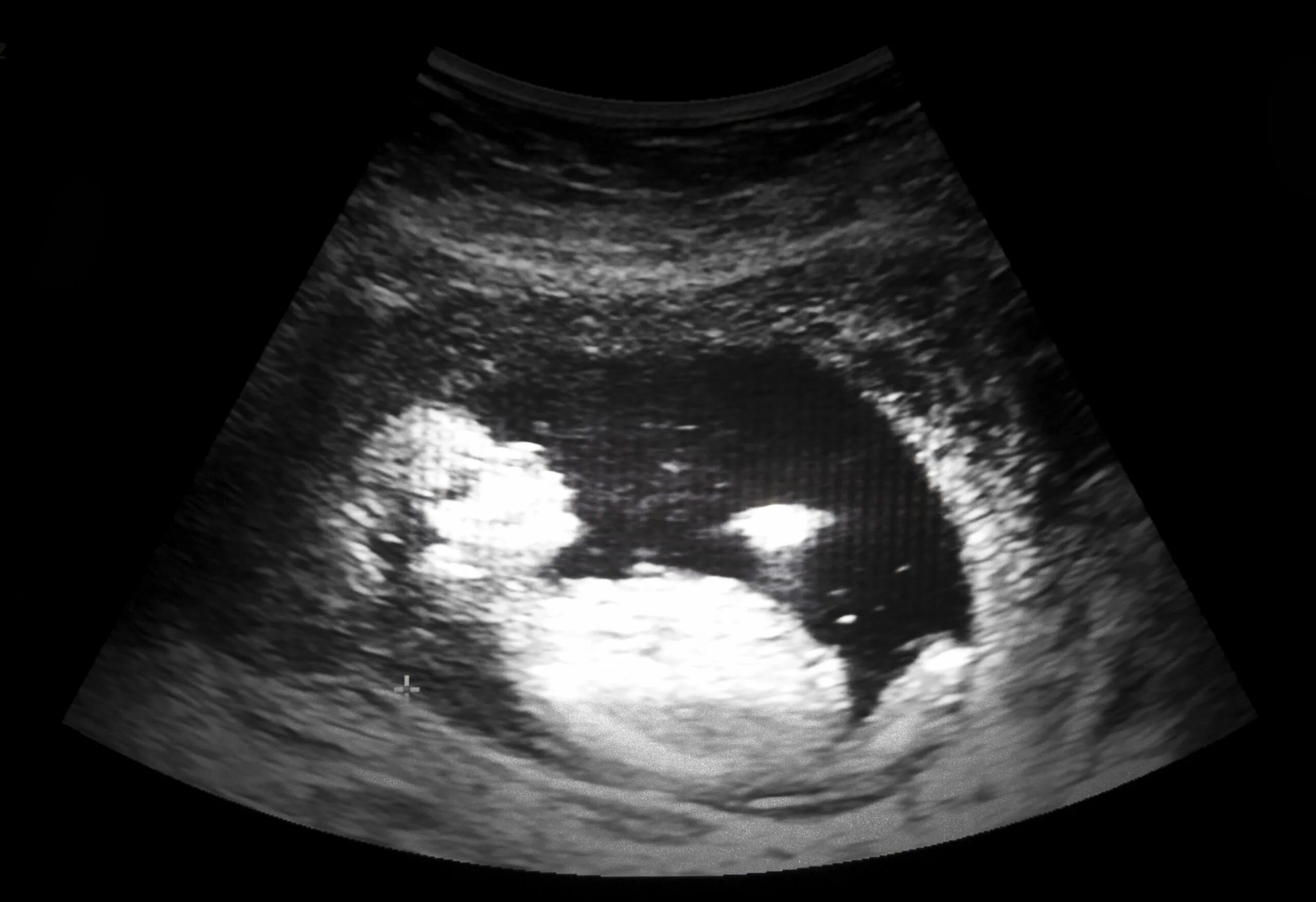 Фото ребенка 13 недель. 13 Недель беременности фото плода. Эмбрион на 13 неделе беременности УЗИ. УЗИ беременной на 13 неделе беременности.