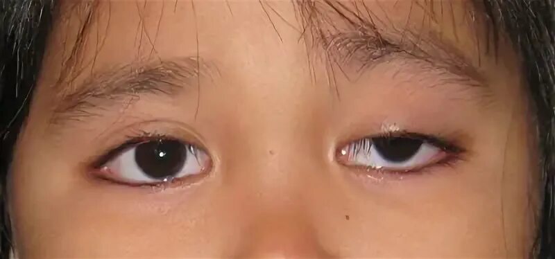 Как выглядит ленивый глаз The medical term for misaligned eyes is strabismus. Nursing care plan, Nursing c